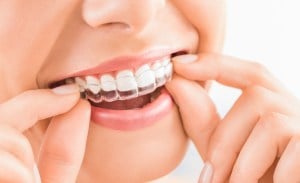 Summer Special on Clear Aligners